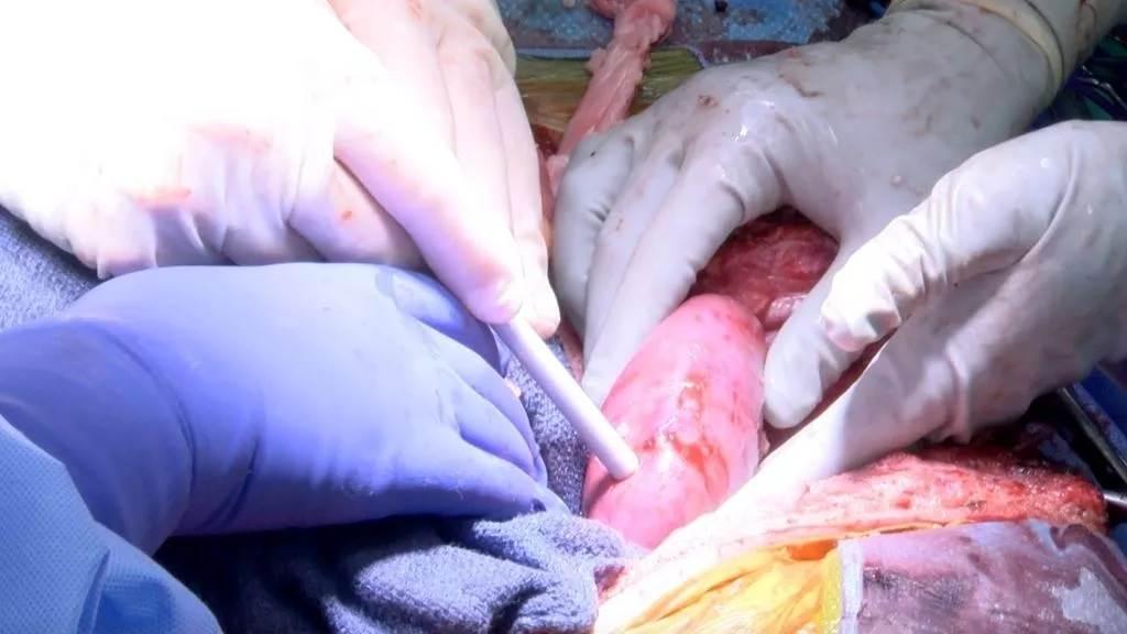 在最近的一項實驗中，將基改豬的腎臟，植入腦亡患者體內，實驗豬腎能否在人體內運作。(圖/阿拉巴馬大學)