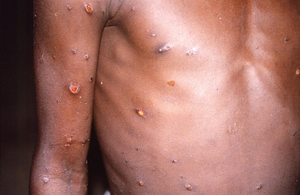 感染猴痘症狀通常是發燒、肌肉疼痛、淋巴結腫大、畏寒、疲倦，還有手部和臉部的皮疹。(圖/路透社) 