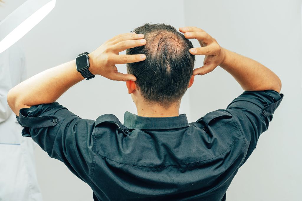 醫師表示，這是雄性禿的徵兆，40歲前男性出現雄性禿的比例約1～2成，70歲後則高達4～6成。(示意圖/ Shutterstock )